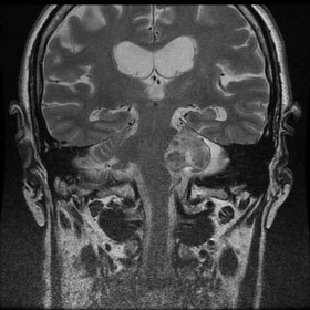 Mi hanno fatto questa diagnosi: che fare? - Microneurochirurgia Rovigo 