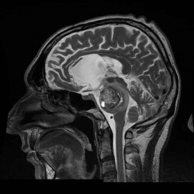 Angioma cavernoso del tronco dell'encefalo con neuronavigazione - Microneurochirurgia Rovigo 