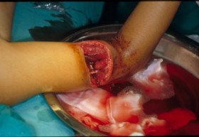 lesioni dei tronchi nervosi periferici - Microneurochirurgia Rovigo 