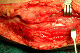 Sindrome del tunnel cubitale (o del nervo ulnare al gomito) - Microneurochirurgia Rovigo 