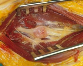 fibromatosi aggressiva - Microneurochirurgia Rovigo 